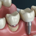 Corona dental 3D